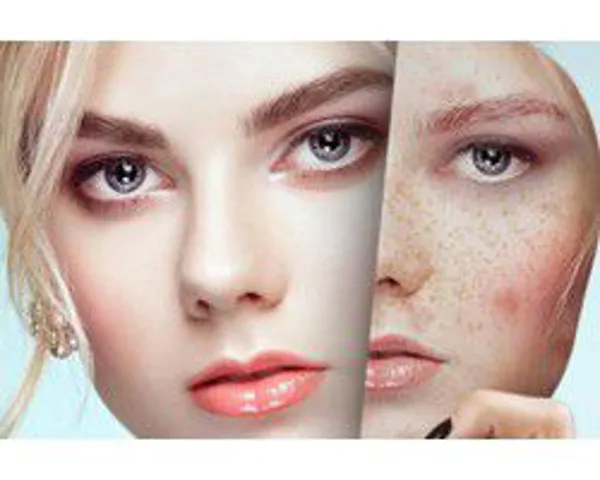 Birthmark, sunspot, and age spot creams